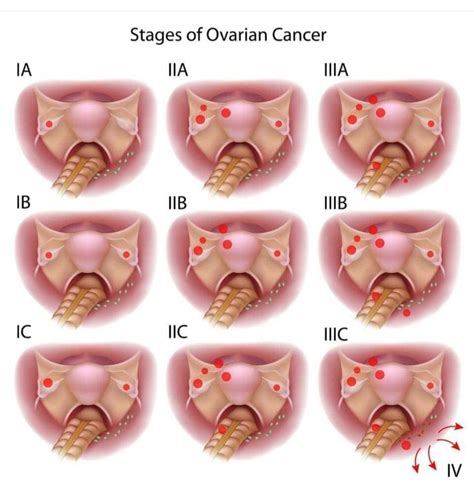 chronic vulvar pruritus) commonly associ-. . Early stages of vulvar cancer pictures